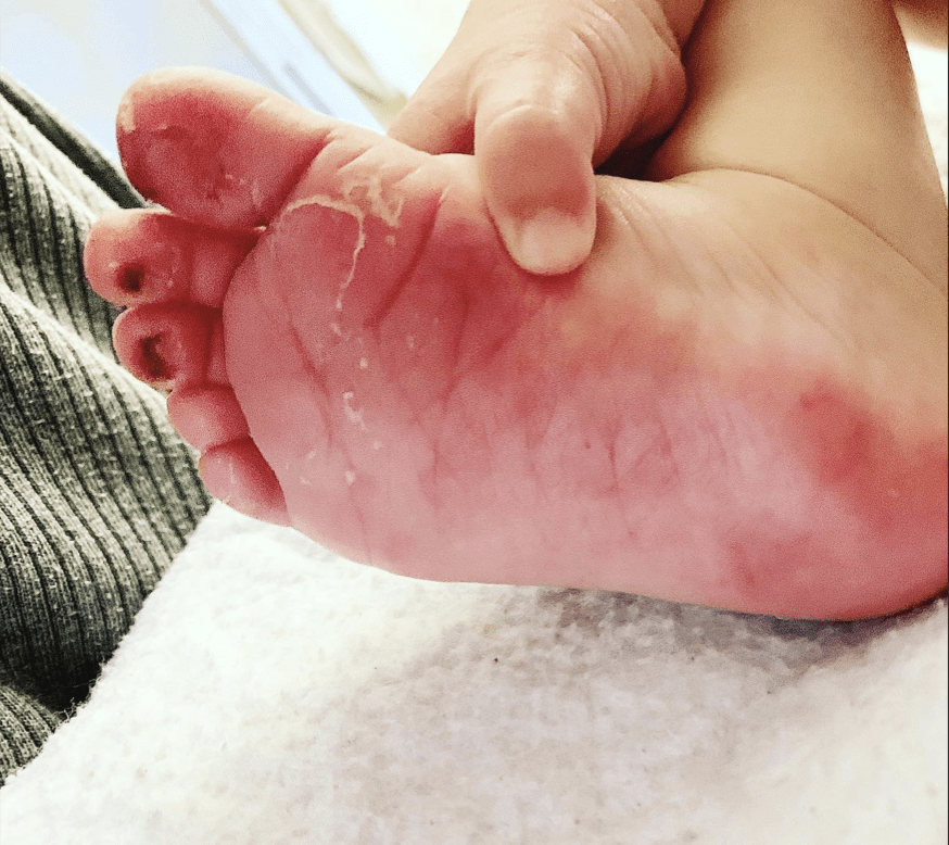 Olives feet with burns and holes after chemotherapy treatment.